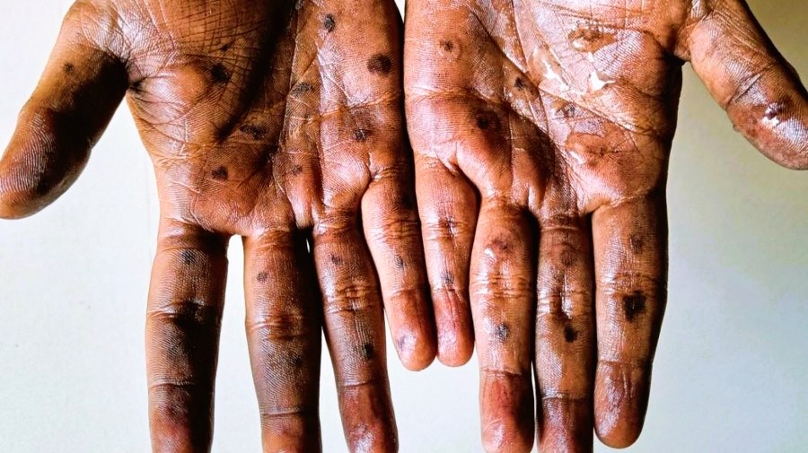 ANGOLA REGISTA 19 NOVOS CASOS DE MPOX E MANTÉM REFORÇO DA VIGILÂNCIA EPIDEMIOLÓGICA